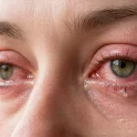 Baharın habercisi… Alerjik Konjonktivit